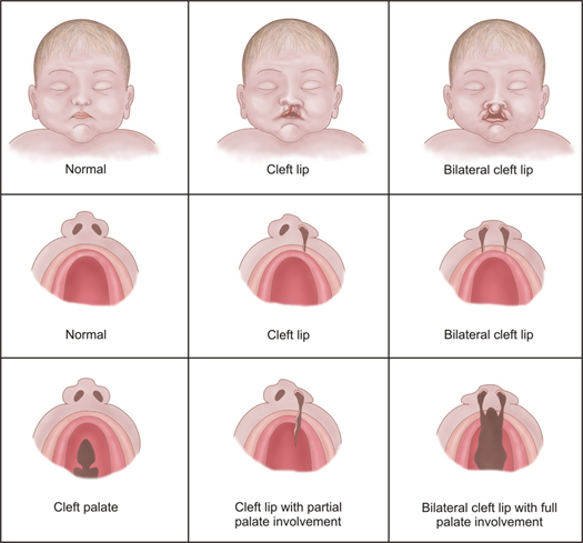 Brush Up On Your Knowlege Of Cleft Palates With Great Web Resources What Speech Therapists